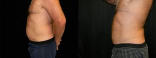 Before and after Liposuction case 32752 - Angle 2