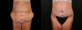 Before and after After Weight Loss case 32754 - Angle 1
