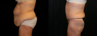 Before and after After Weight Loss case 32754 - Angle 2