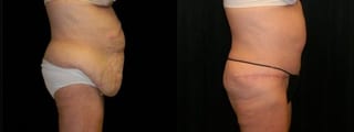 Before and after After Weight Loss case 32754 - Angle 3