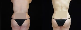 Before and after Liposuction case 32755 - Angle 1