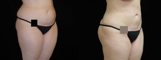 Before and after Liposuction case 32755 - Angle 3