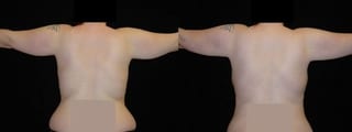 Before and after Liposuction case 32755 - Angle 4