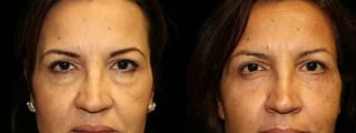 Before and after Blepharoplasty case 32758 - Angle 1