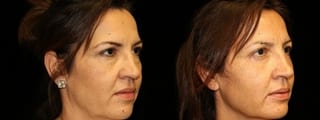 Before and after Blepharoplasty case 32758 - Angle 2