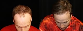 Before and after Hair Transplantation case 32759 - Angle 2