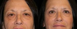 Before and after Blepharoplasty case 32760 - Angle 1