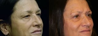Before and after Blepharoplasty case 32760 - Angle 2