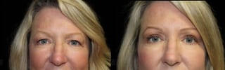 Before and after Blepharoplasty case 32761 - Angle 1