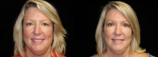 Before and after Blepharoplasty case 32761 - Angle 2