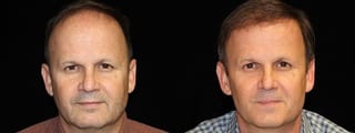 Before and after Hair Transplantation case 32763 - Angle 1