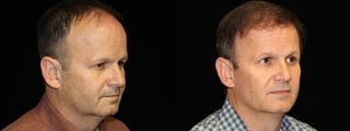 Before and after Hair Transplantation case 32763 - Angle 2