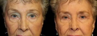 Before and after Blepharoplasty case 32762 - Angle 1