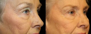 Before and after Blepharoplasty case 32762 - Angle 2