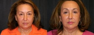 Before and after Blepharoplasty case 32764 - Angle 1
