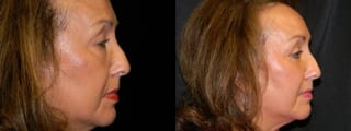 Before and after Blepharoplasty case 32764 - Angle 2
