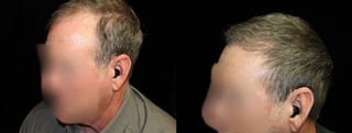 Before and after Hair Transplantation case 32765 - Angle 2