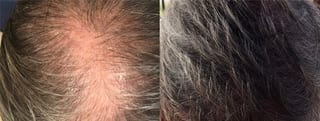 Before and after Hair Transplantation case 32765 - Angle 3