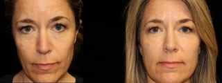 Before and after Injectables - Face case 32766 - Angle 1