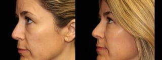 Before and after Injectables - Face case 32766 - Angle 3