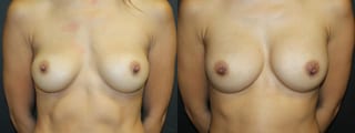 Before and after Breast Revision case 32770 - Angle 1