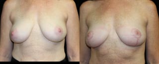 Before and after Breast Lift case 32771 - Angle 1