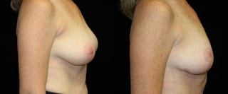 Before and after Breast Lift case 32771 - Angle 3