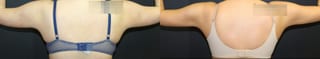 Before and after Liposuction case 32767 - Angle 1