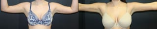 Before and after Liposuction case 32767 - Angle 2