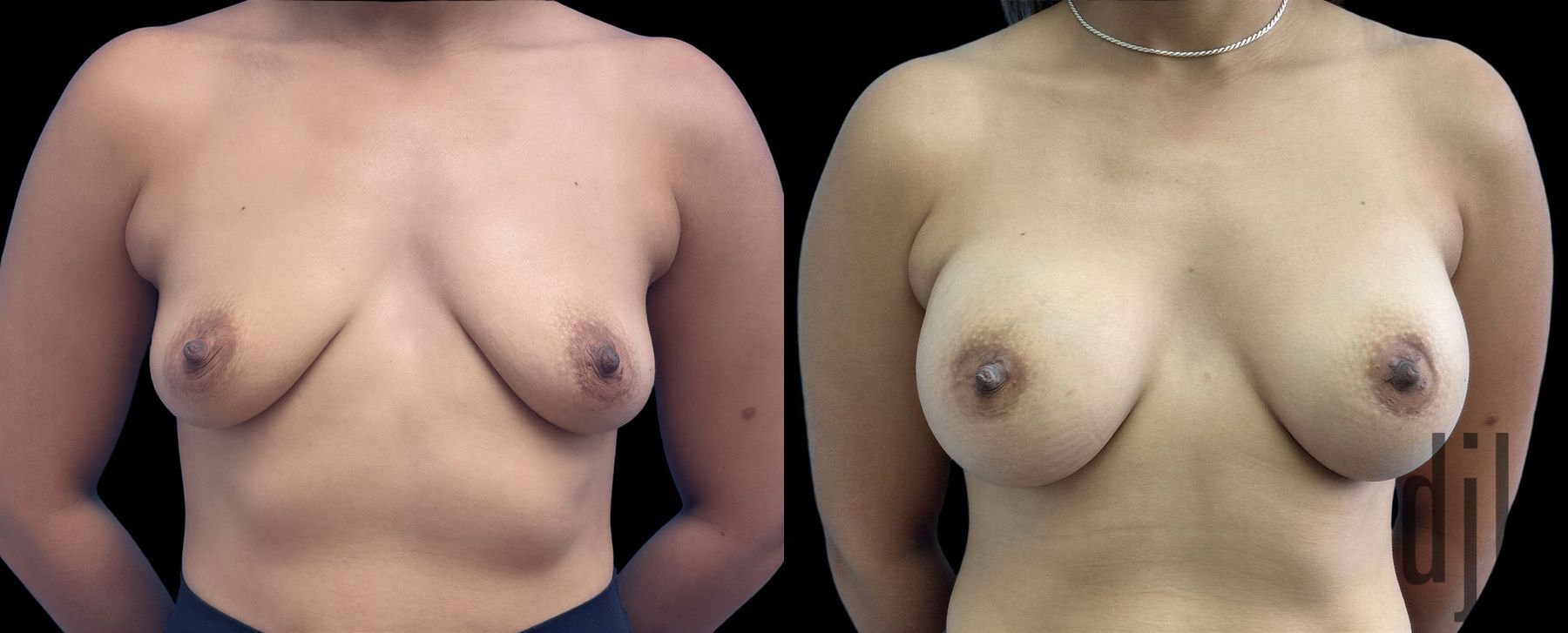 Before and after Breast Augmentation case 43051