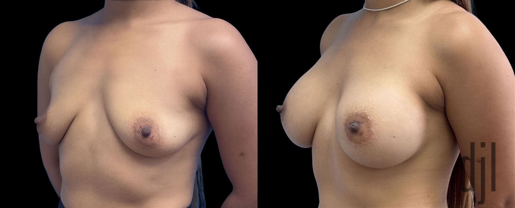 Before and after Breast Augmentation case 43051 - Angle 2