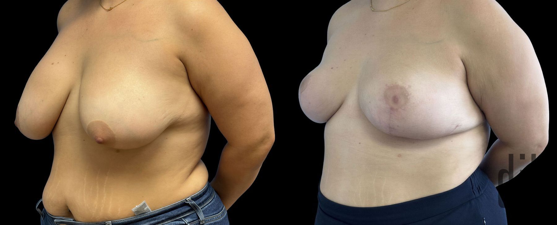 Before and after Explant Mastopexy case 42872 - Angle 2