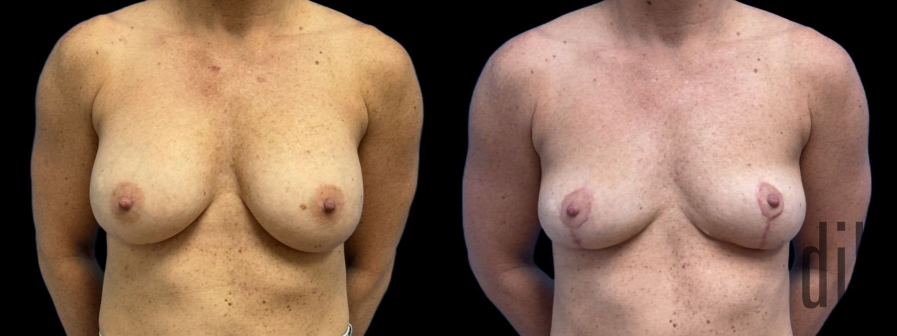Before and after Breast Implant Removal case 43148