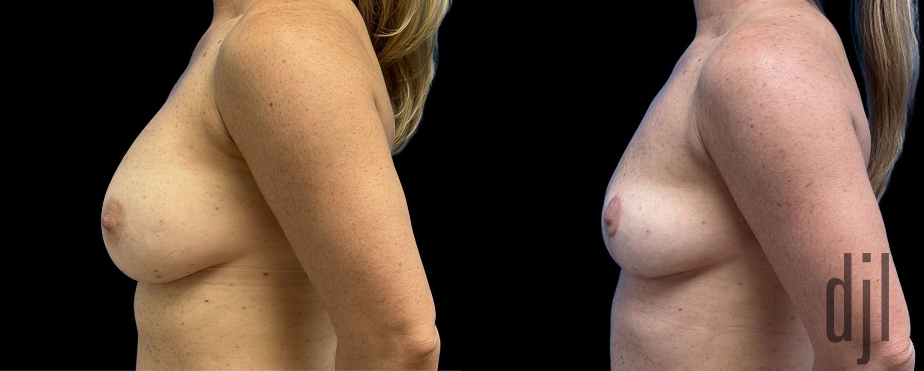 Before and after Breast Implant Removal case 43148 - Angle 2