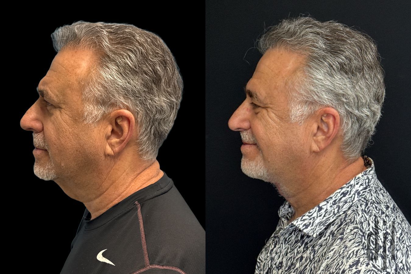 Before and after Direct Neck Lift case 43373 - Angle 2