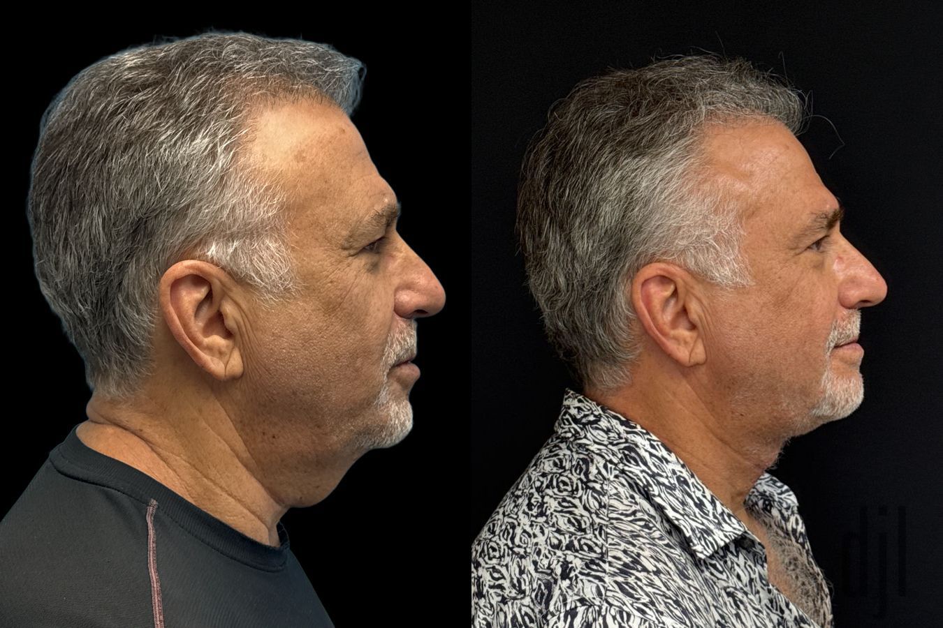 Before and after Direct Neck Lift case 43373