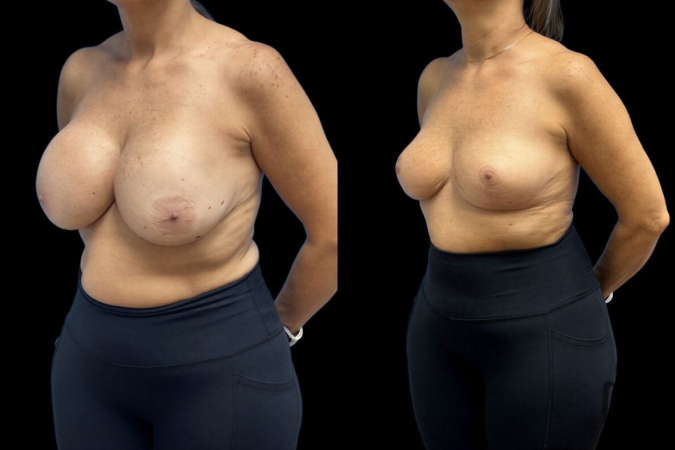 Before and after Explant Mastopexy case 41347 - Angle 2