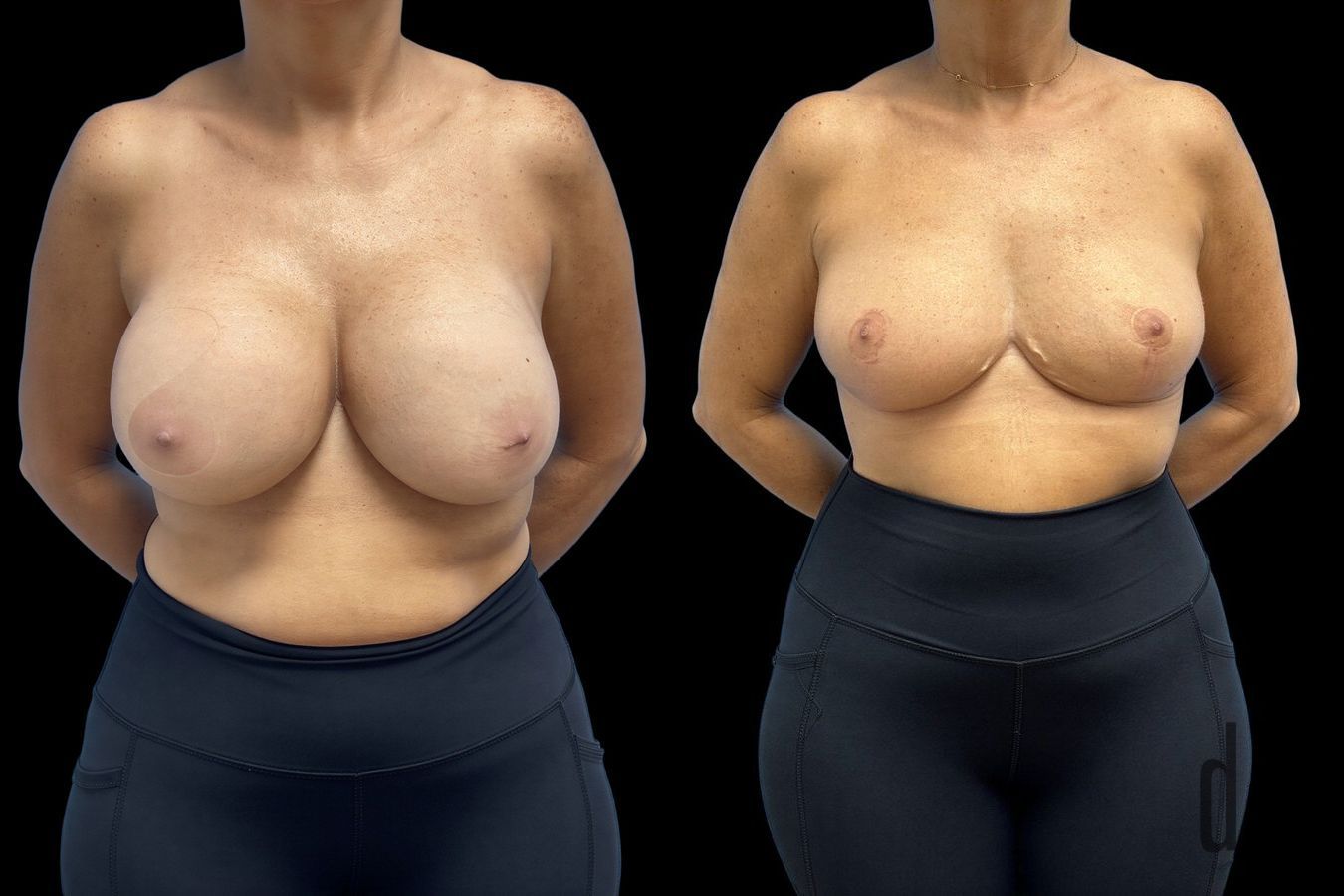 Before and after Explant Mastopexy case 41347