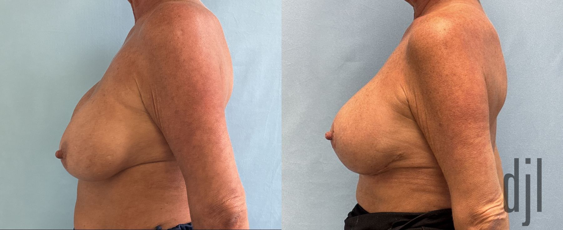 Before and after Implant Replacement Mastopexy case 46405 - Angle 3