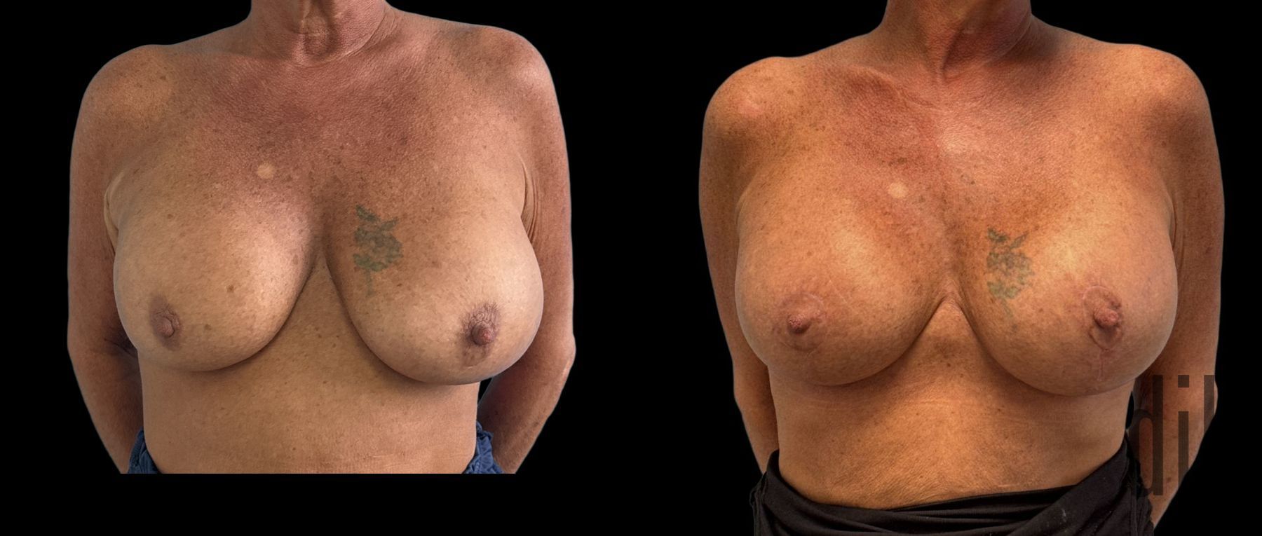 Before and after Implant Replacement Mastopexy case 46405