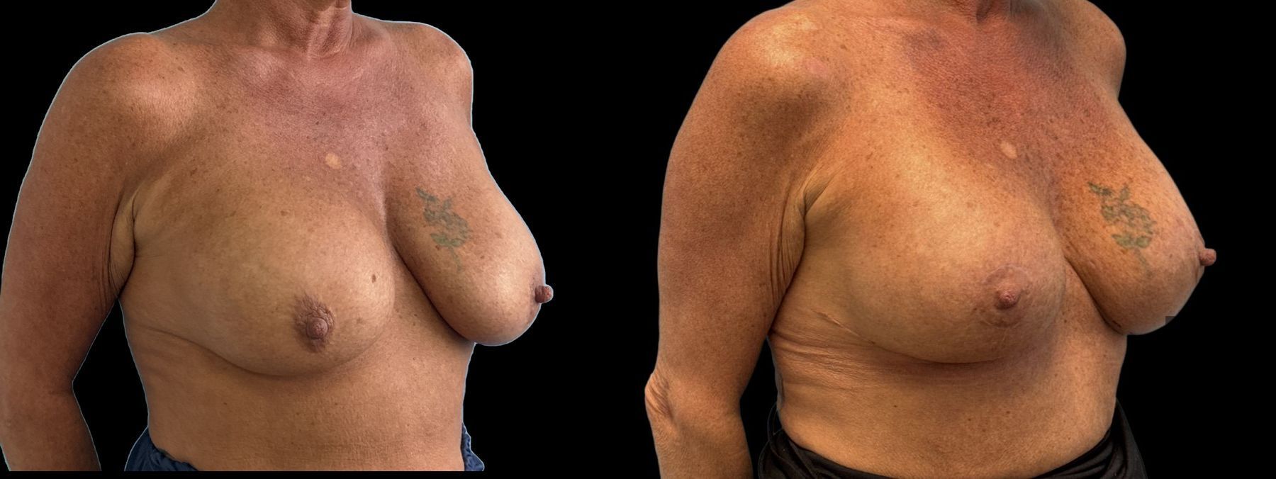Before and after Implant Replacement Mastopexy case 46405 - Angle 2