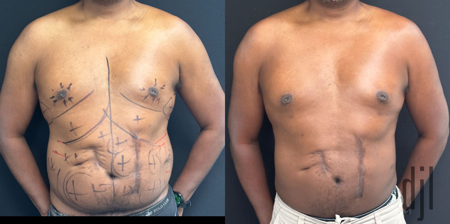 Before and after Liposuction with Renuvion case 50041