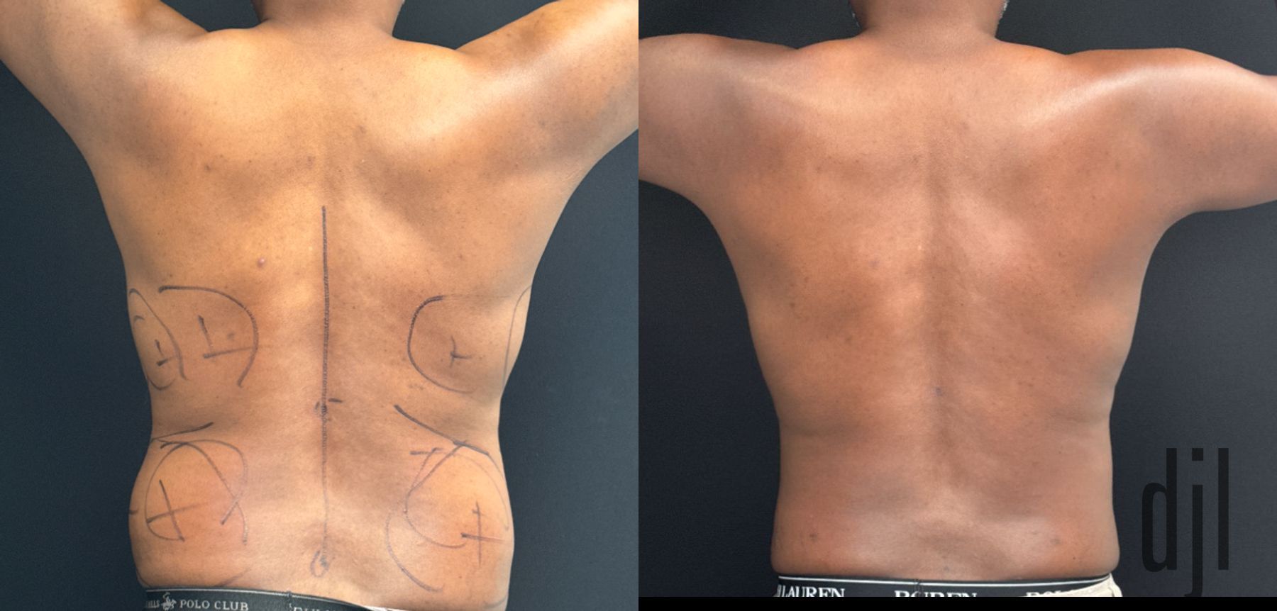 Before and after Liposuction with Renuvion case 50041 - Angle 2