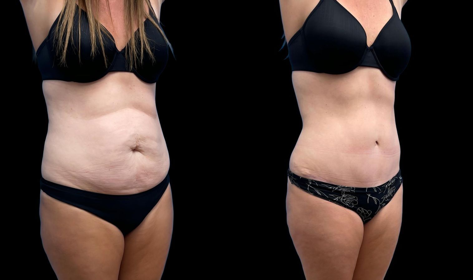 Before and after Tummy Tuck case 46411 - Angle 2