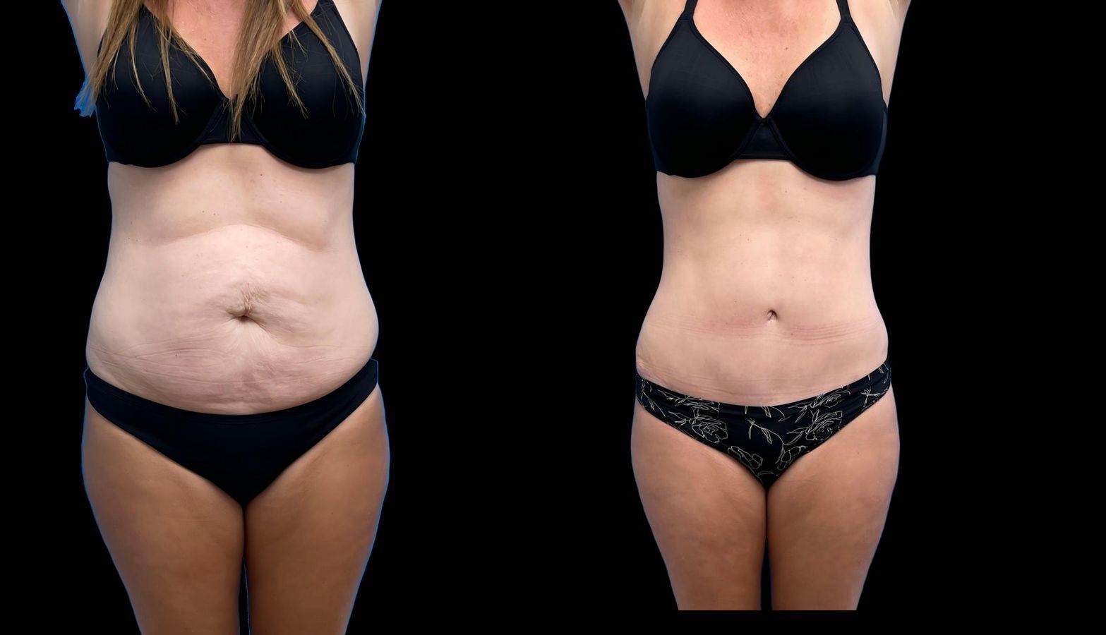 Before and after Tummy Tuck case 46411