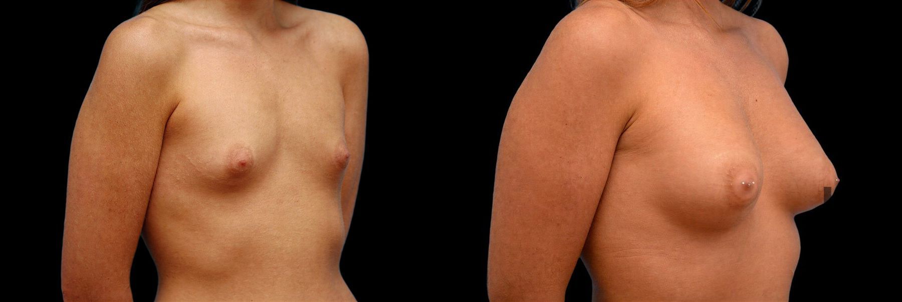 Before and after Breast Augmentation case 42803 - Angle 2