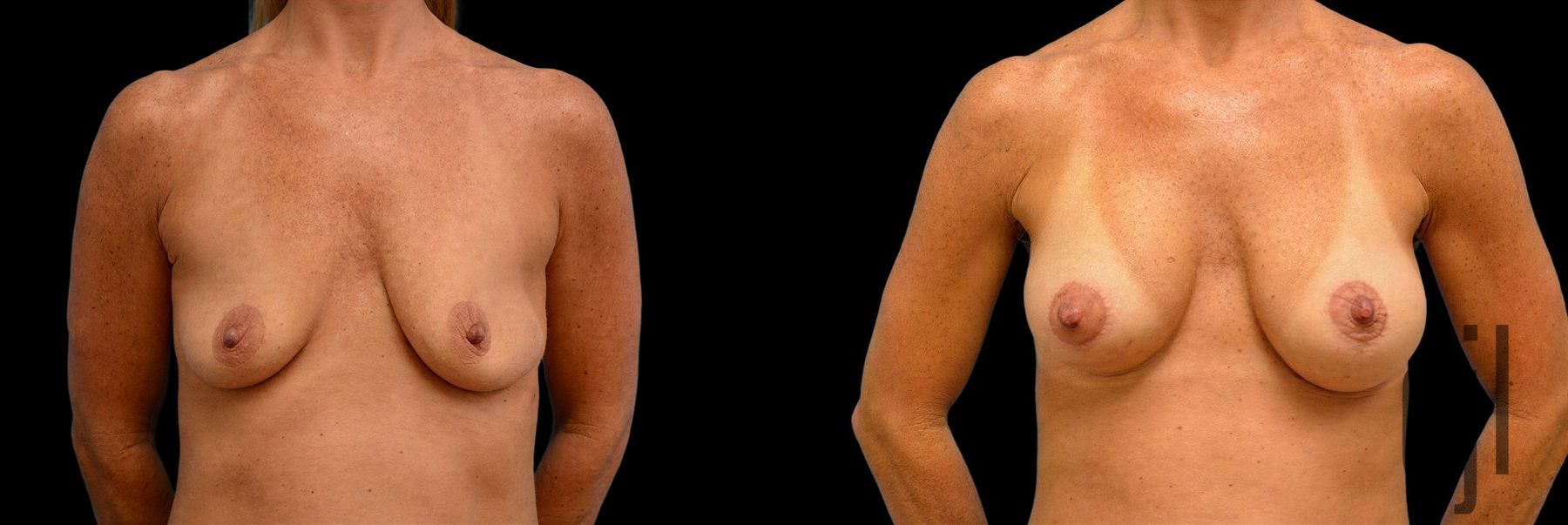 Before and after Breast Augmentation with Lift case 42705