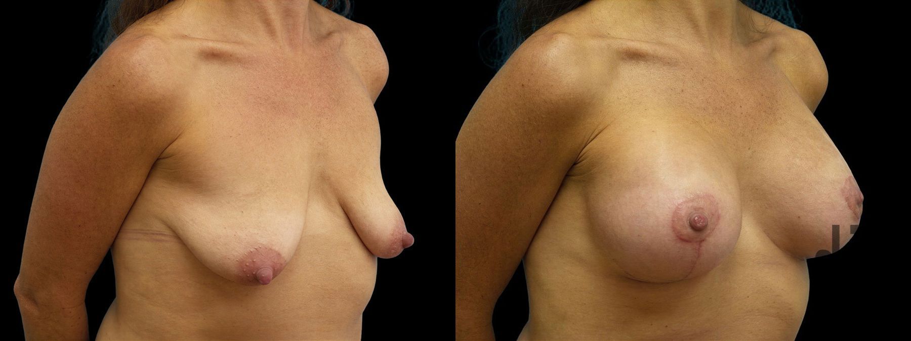 Before and after Breast Augmentation with Lift case 42854 - Angle 2