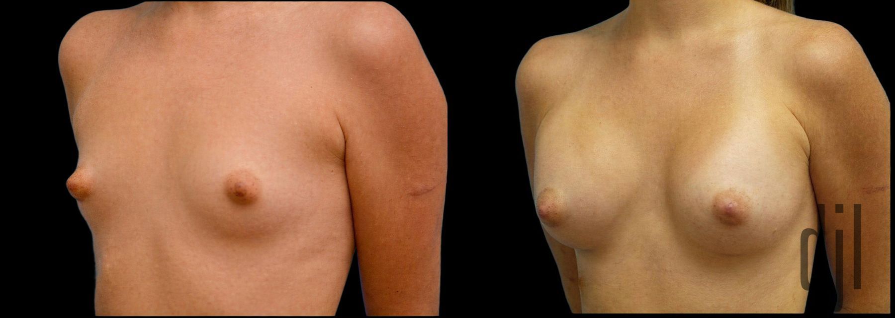 Before and after Breast Augmentation case 42926 - Angle 2