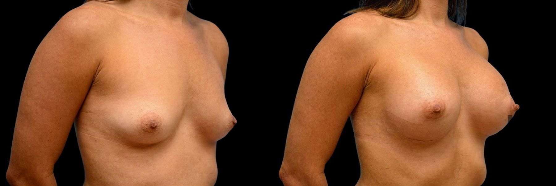 Before and after Breast Augmentation case 42801 - Angle 2